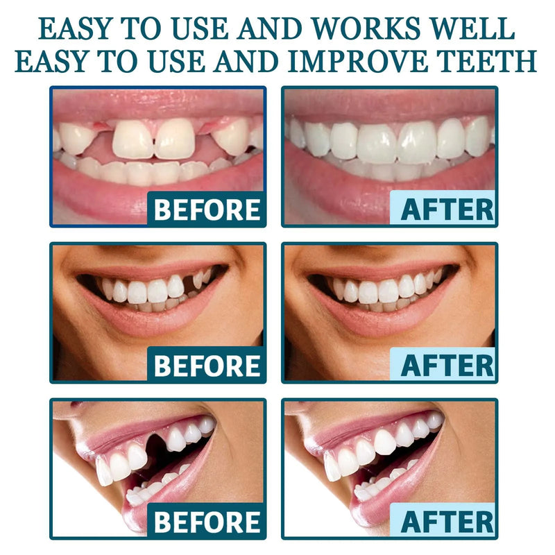 Dentadura Estética Temporária – Sorriso Imediato